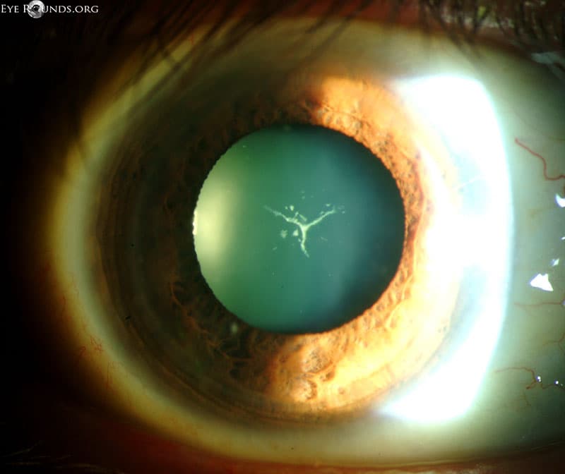 Clinical ophthalmic photograph of "y suture" cataract - cataract condition