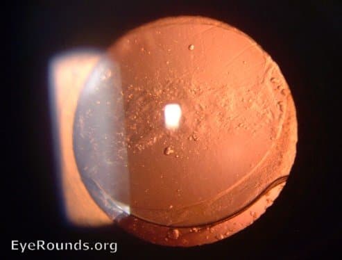 Clinical ophthalmic photograph of aftercataract elschnigs pearls - cataract condition