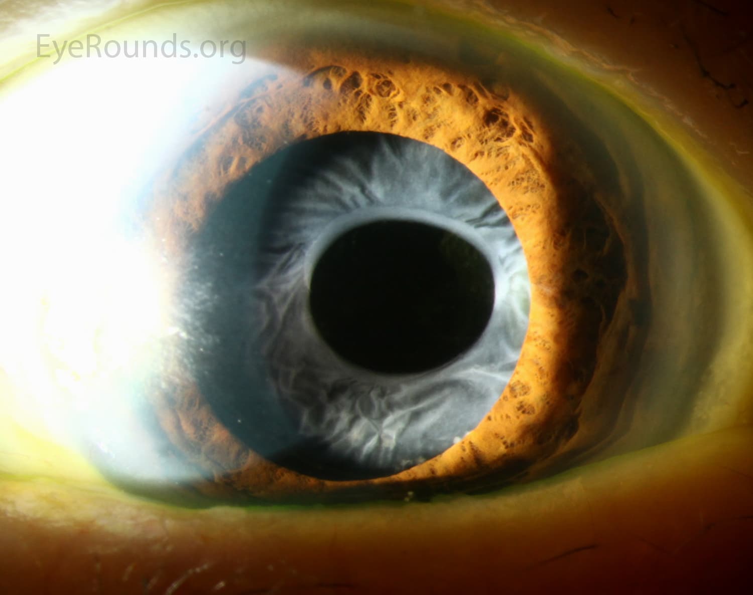 Clinical ophthalmic photograph of anterior capsular phimosis - cataract condition