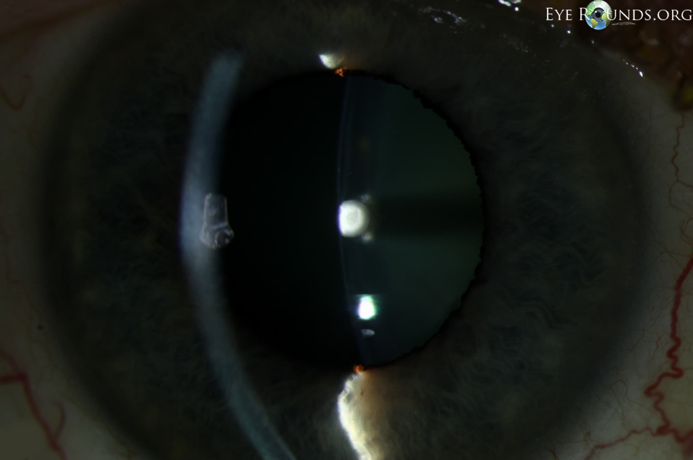 Clinical ophthalmic photograph of anterior polar cataract - cataract condition