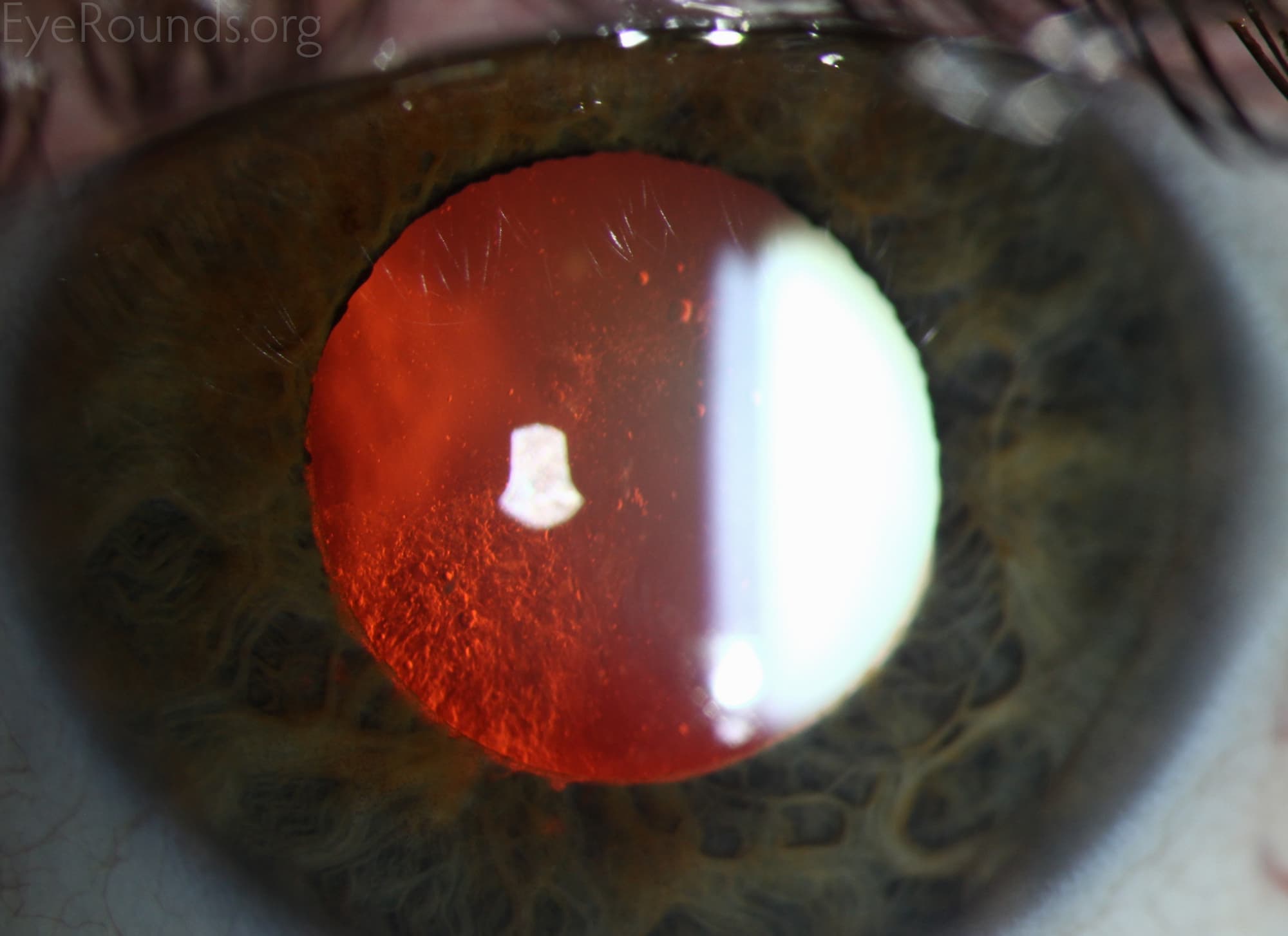 Clinical ophthalmic photograph of anterior subcapsular cataract - cataract condition