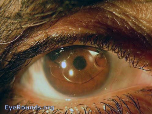 Clinical ophthalmic photograph of artisanclaw intraocular lens - cataract condition