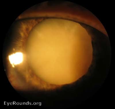 Clinical ophthalmic photograph of brunescent cataract, mature - cataract condition