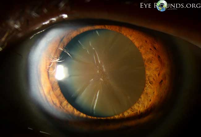Clinical ophthalmic photograph of brunescent cataract - cataract condition