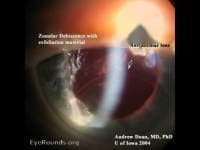 Clinical ophthalmic photograph of pseudoexfoliation zonular dehiscence - cataract condition