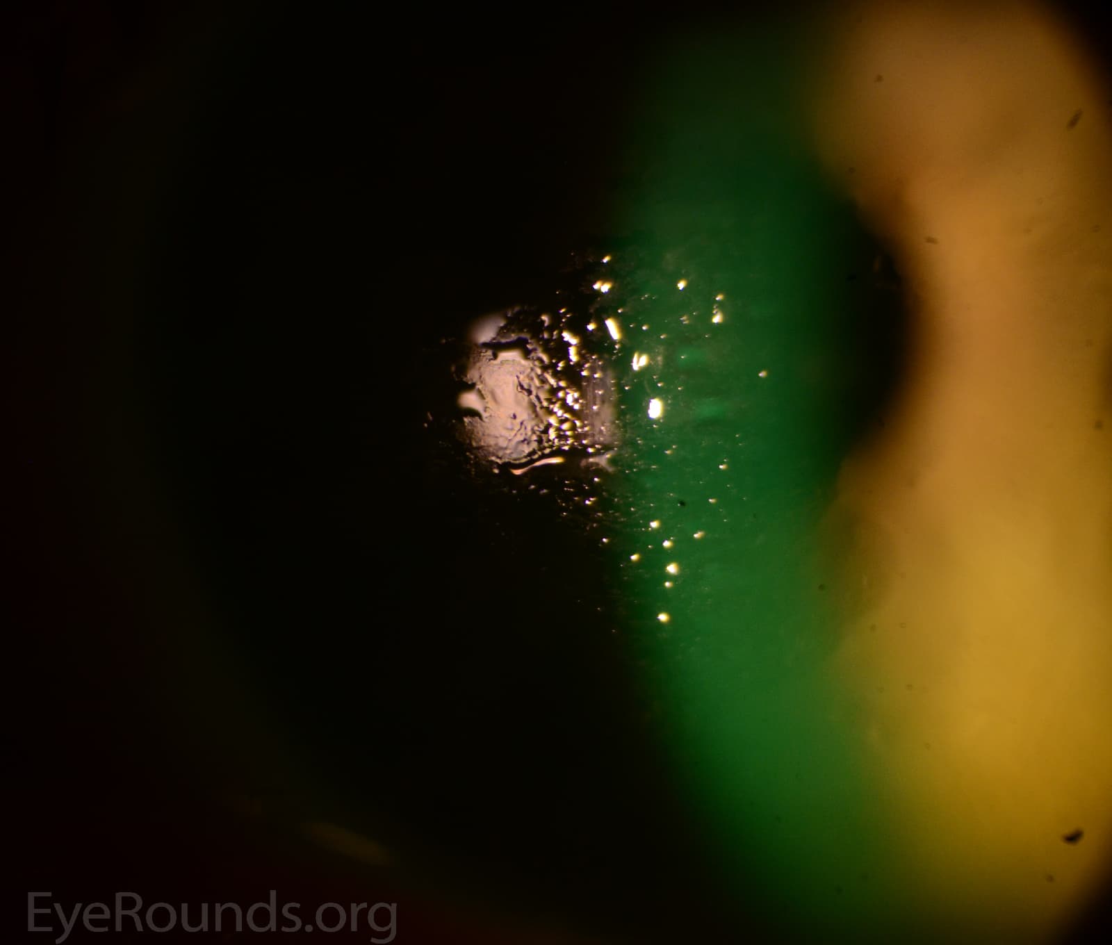 Clinical ophthalmic photograph of lipid deposits on scleral rigid gas permeable rgp lens - contact lens condition