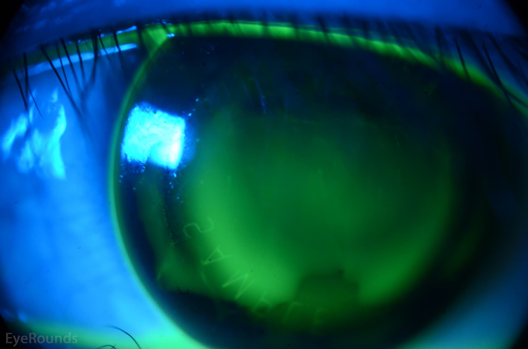 Clinical ophthalmic photograph of orthokeratology - contact lens condition