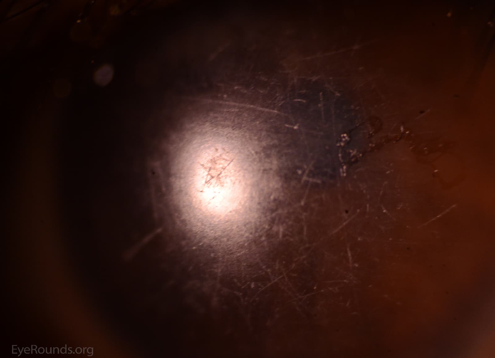 Clinical ophthalmic photograph of scratched scleral rigid gas permeable rgp lens - contact lens condition