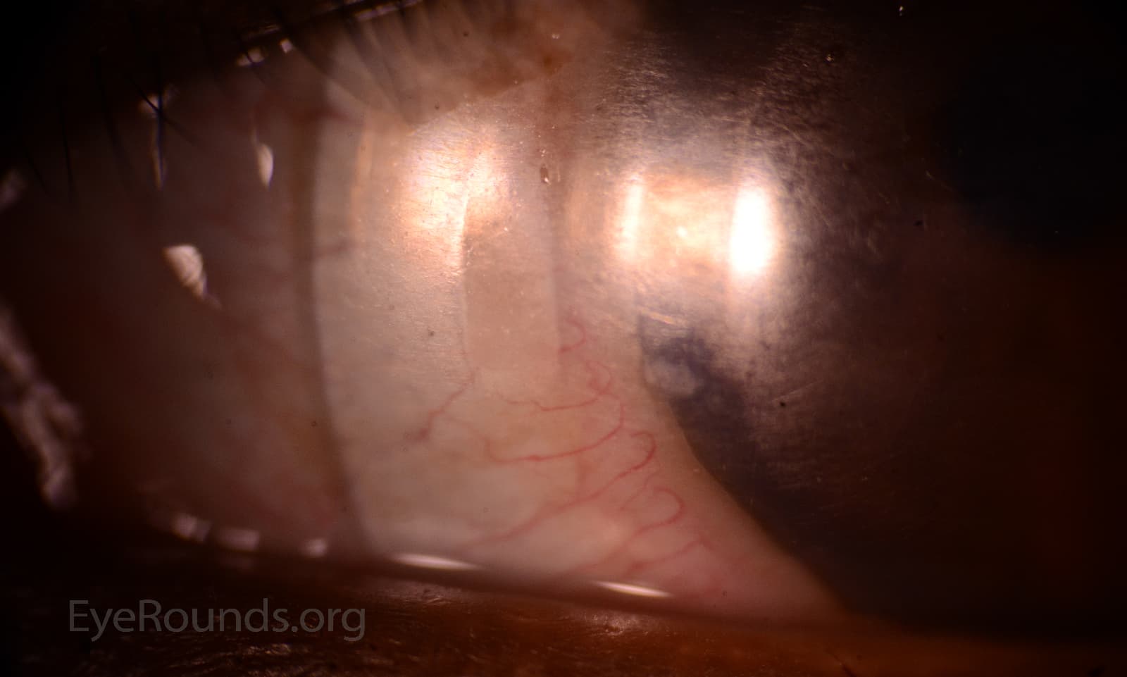 Clinical ophthalmic photograph of surface coating loss on scleral lens - contact lens condition