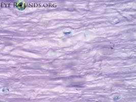 Clinical ophthalmic photograph of acanthamoeba keratitis - cornea condition