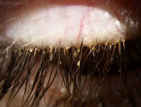 Clinical ophthalmic photograph of blepharitis - cornea condition