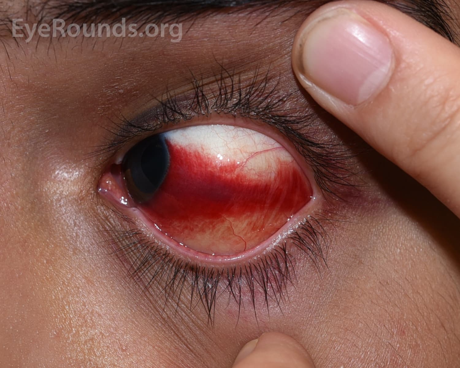 Clinical ophthalmic photograph of subconjunctival hemorrhage - cornea condition