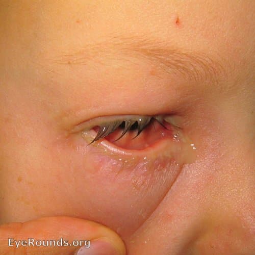 Clinical ophthalmic photograph of bacterial conjunctivitis - external disease condition