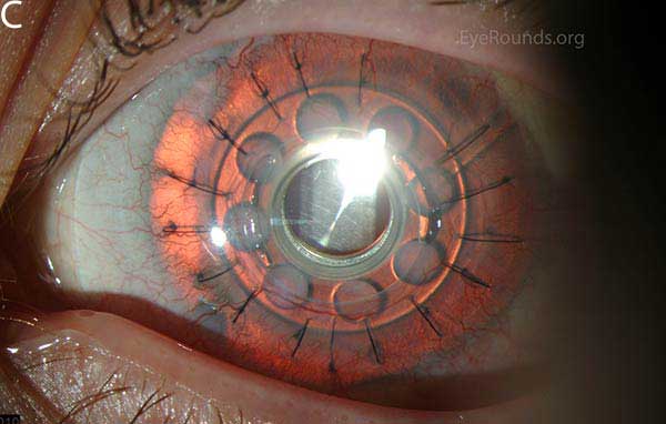 Clinical ophthalmic photograph of boston keratoprosthesis kpro for congenital aniridia - external disease condition