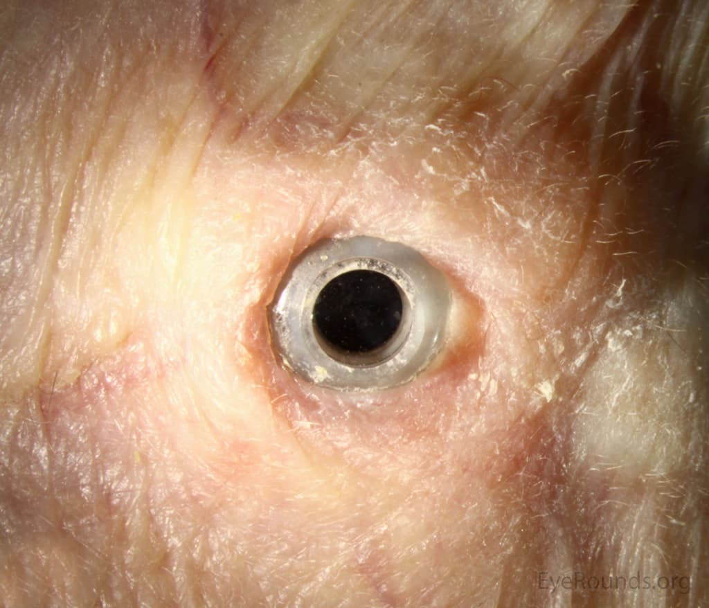 Clinical ophthalmic photograph of boston type 2 keratoprosthesis kpro - external disease condition