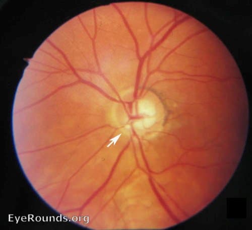 Clinical ophthalmic photograph of branch retinal artery occlusion brao - external disease condition