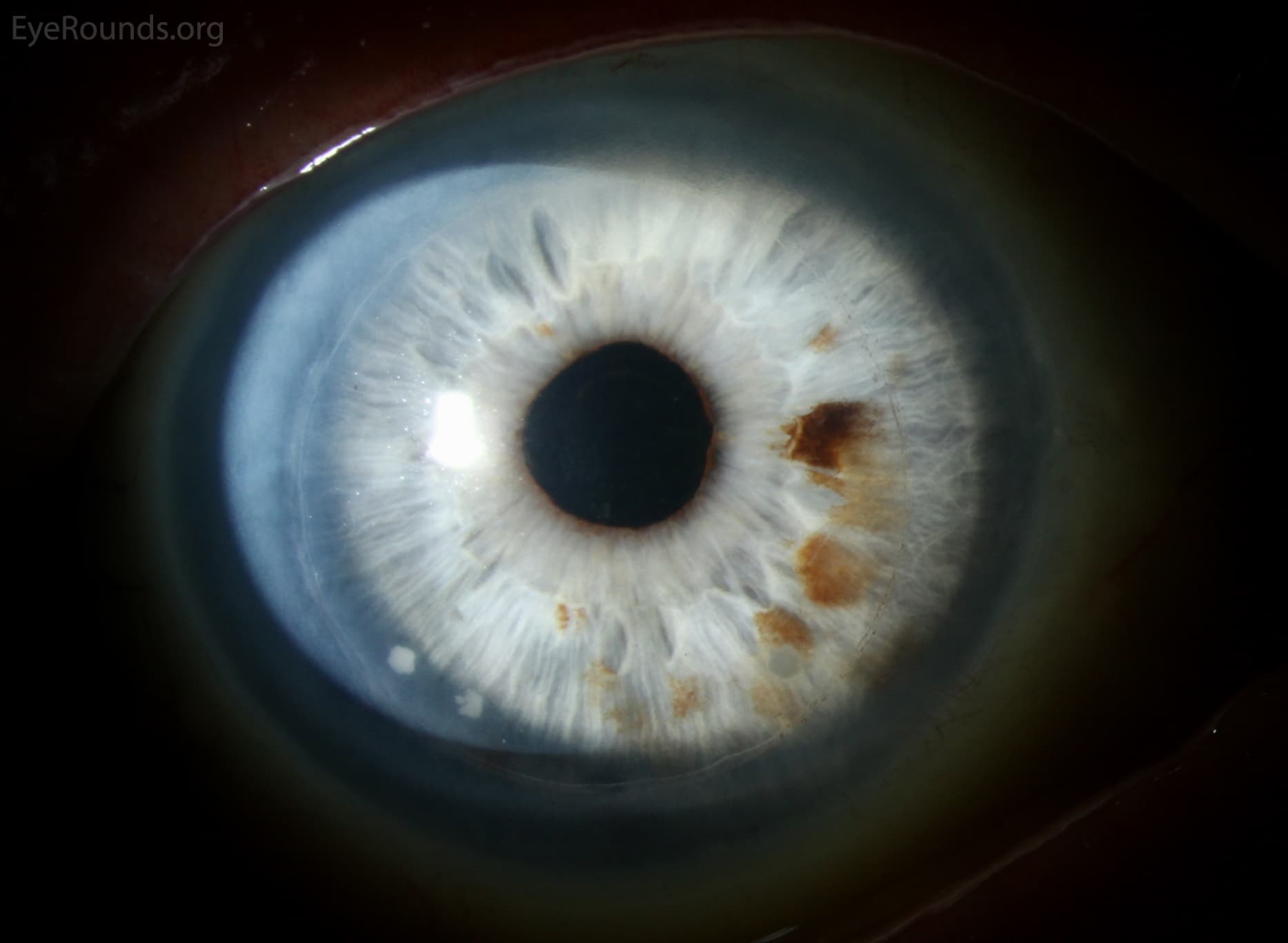 Clinical ophthalmic photograph of candida growth within dsaek interface - external disease condition