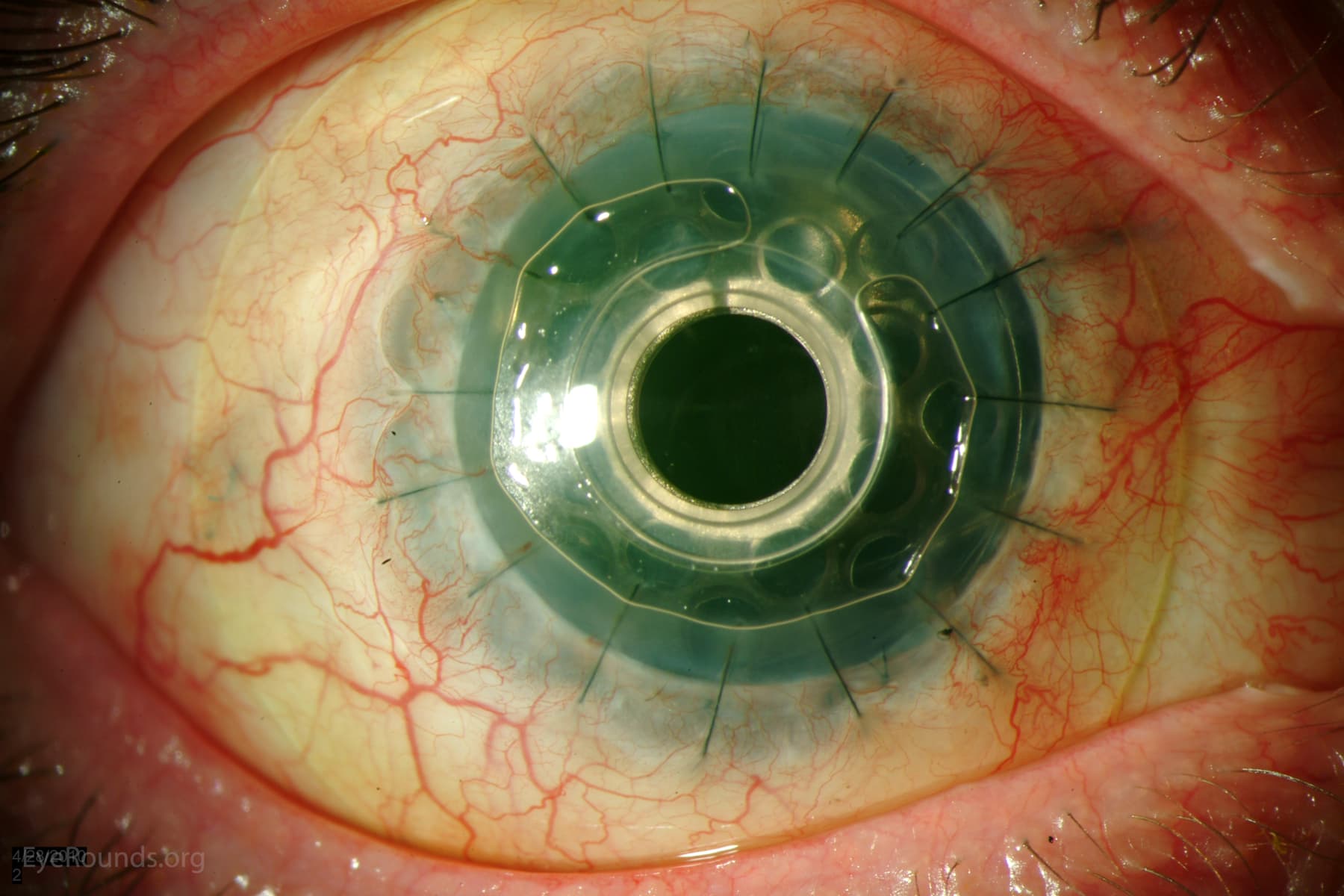 Clinical ophthalmic photograph of candida infection of a boston type i keratoprosthesis kpro - external disease condition