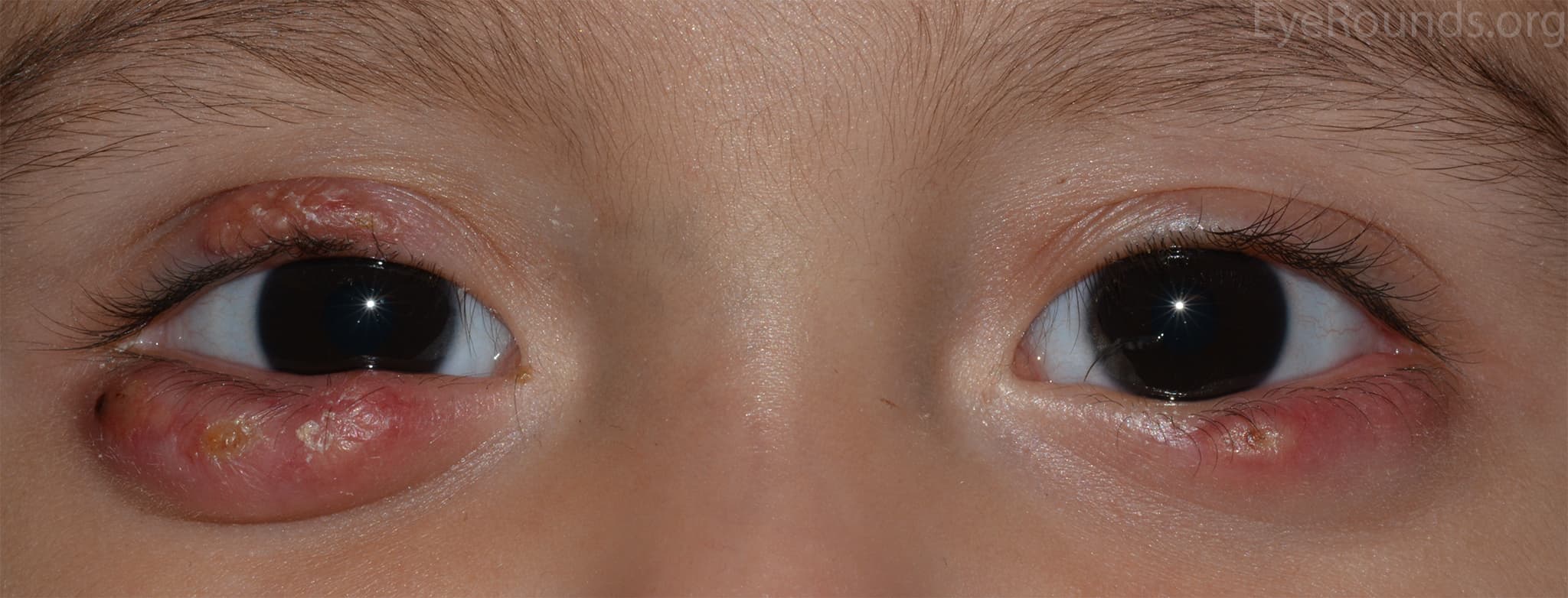 Clinical ophthalmic photograph of chalazia - external disease condition
