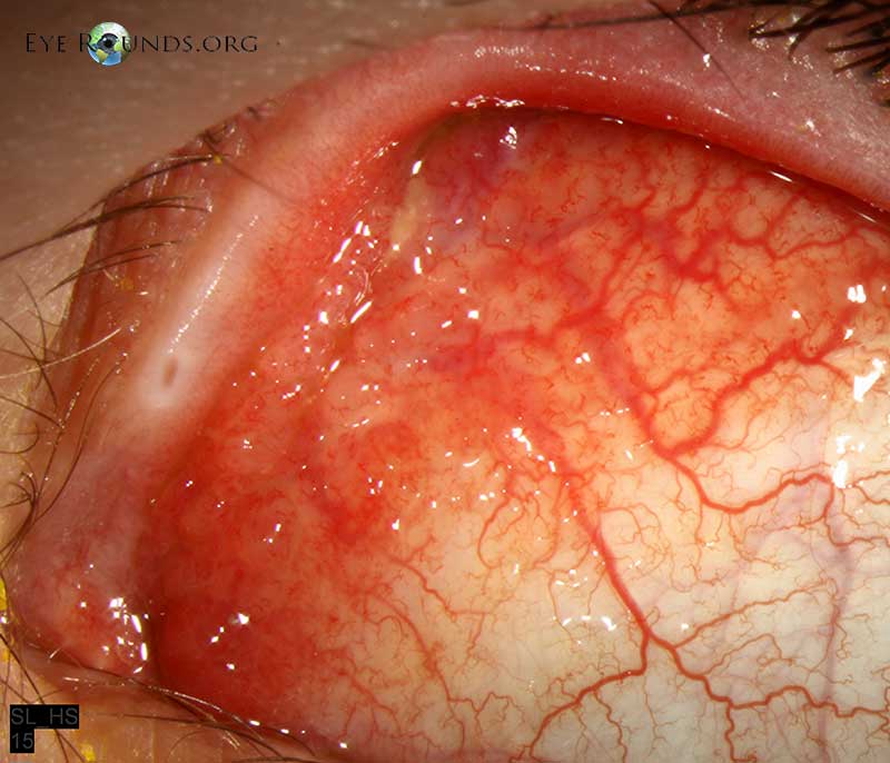 Clinical ophthalmic photograph of chlamydia trachomatis infection - external disease condition