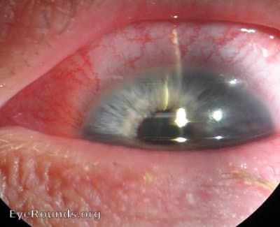 Clinical ophthalmic photograph of ciliary flush - external disease condition