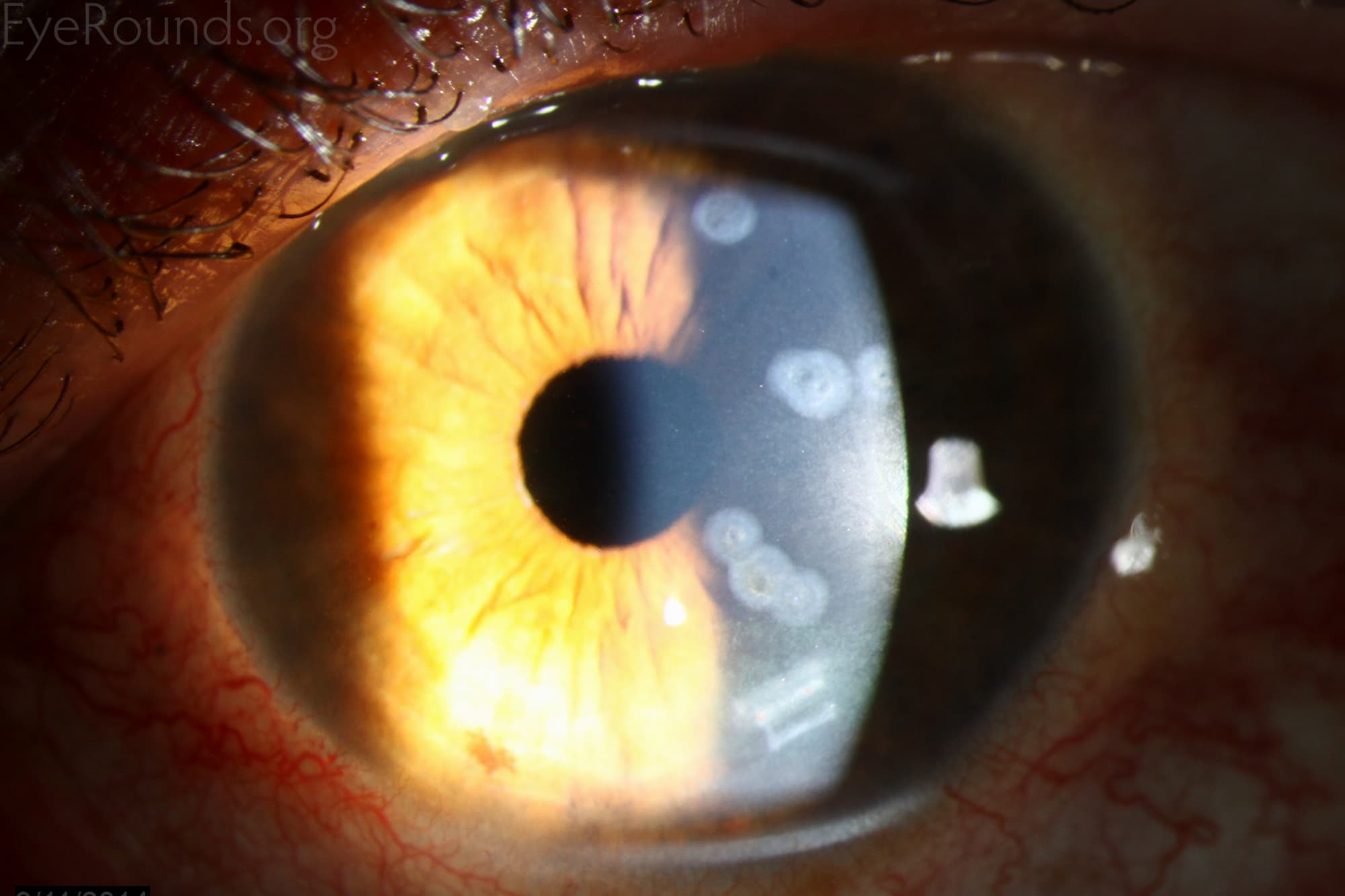 Clinical ophthalmic photograph of conductive keratoplasty - external disease condition