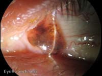 Clinical ophthalmic photograph of conjunctival nevus - external disease condition