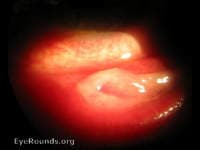Clinical ophthalmic photograph of epidemic keratoconjunctivitis - external disease condition