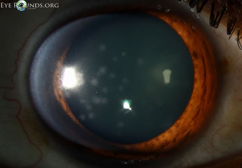 Clinical ophthalmic photograph of epidemic adenoviral keratoconjunctivitis - external disease condition