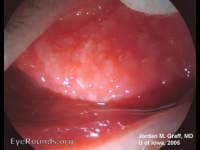 Clinical ophthalmic photograph of giant papillary conjunctivitis - external disease condition