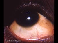 Clinical ophthalmic photograph of icterus jaundice - external disease condition