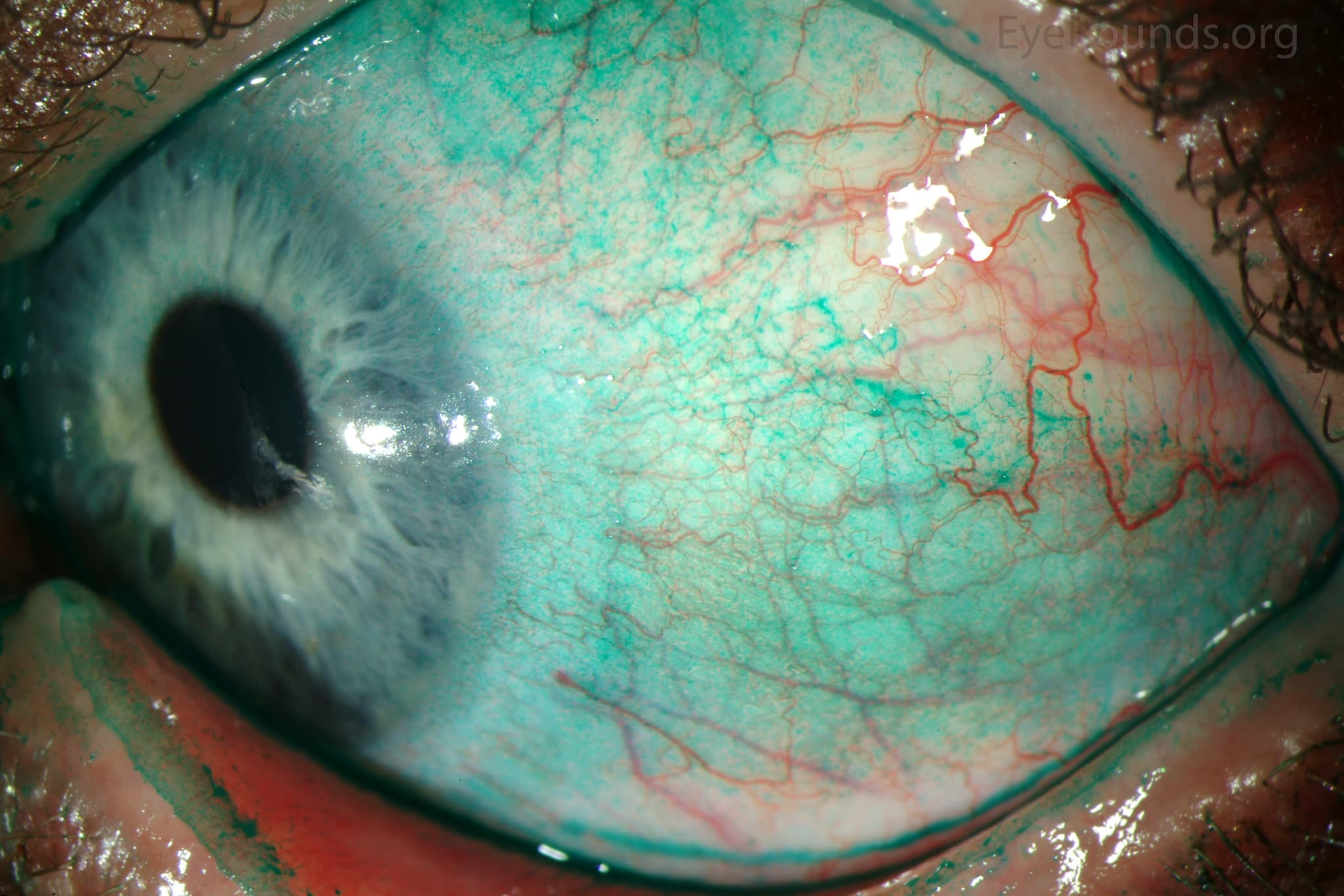Clinical ophthalmic photograph of lissamine green staining in keratoconjunctivitis sicca - external disease condition