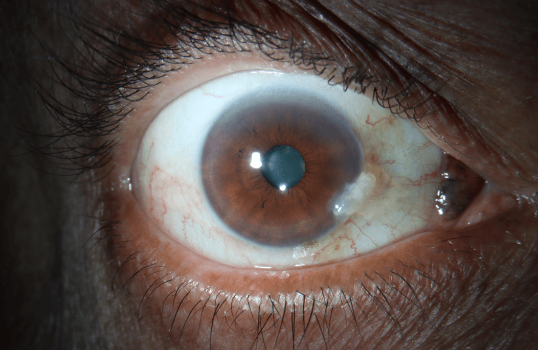 Clinical ophthalmic photograph of pigmented nevus of plica semilunaris - external disease condition