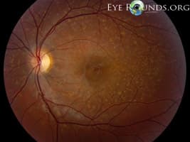 Clinical ophthalmic photograph of stargardt disease - external disease condition