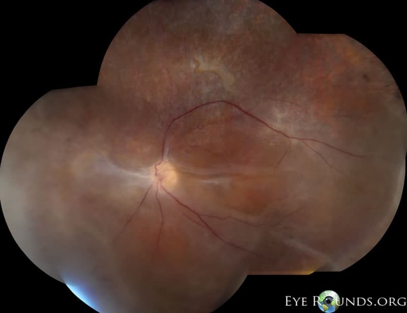 Clinical ophthalmic photograph of autosomal dominant neovascular inflammatory vitreoretinopathy adniv - genetics condition