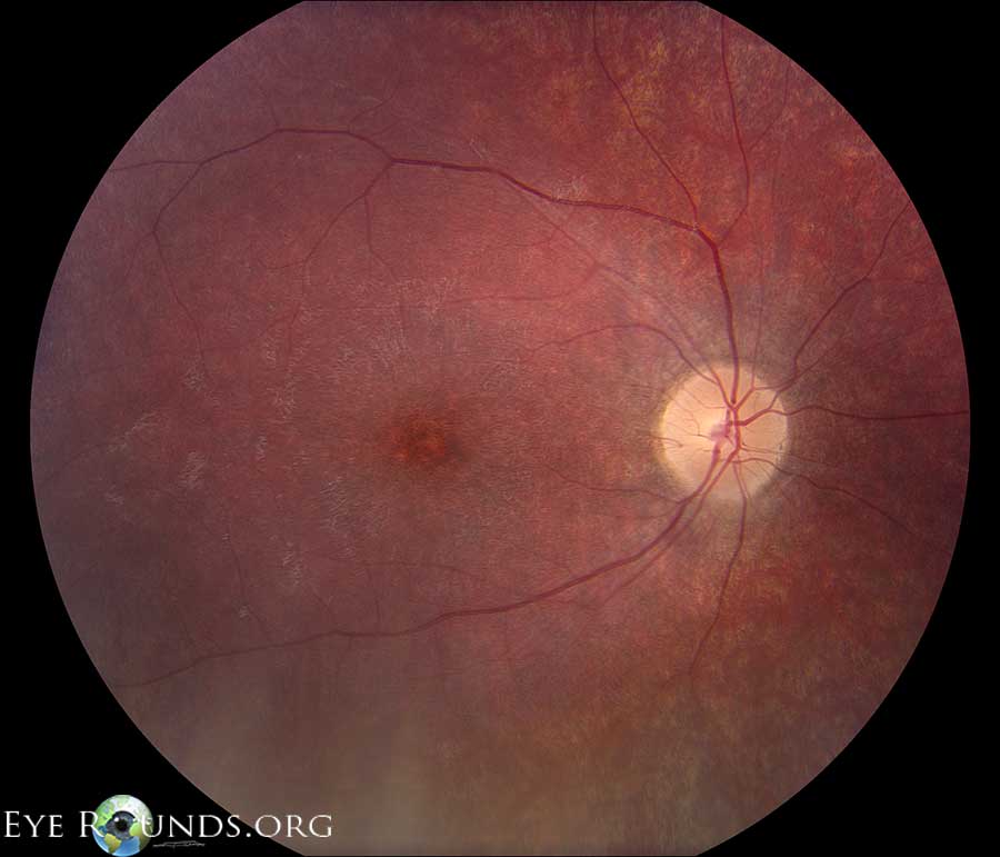 Clinical ophthalmic photograph of batten disease - genetics condition