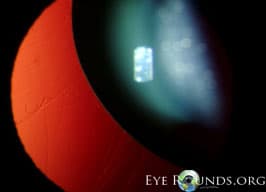 Clinical ophthalmic photograph of ectopia lentis in marfans syndrome - genetics condition