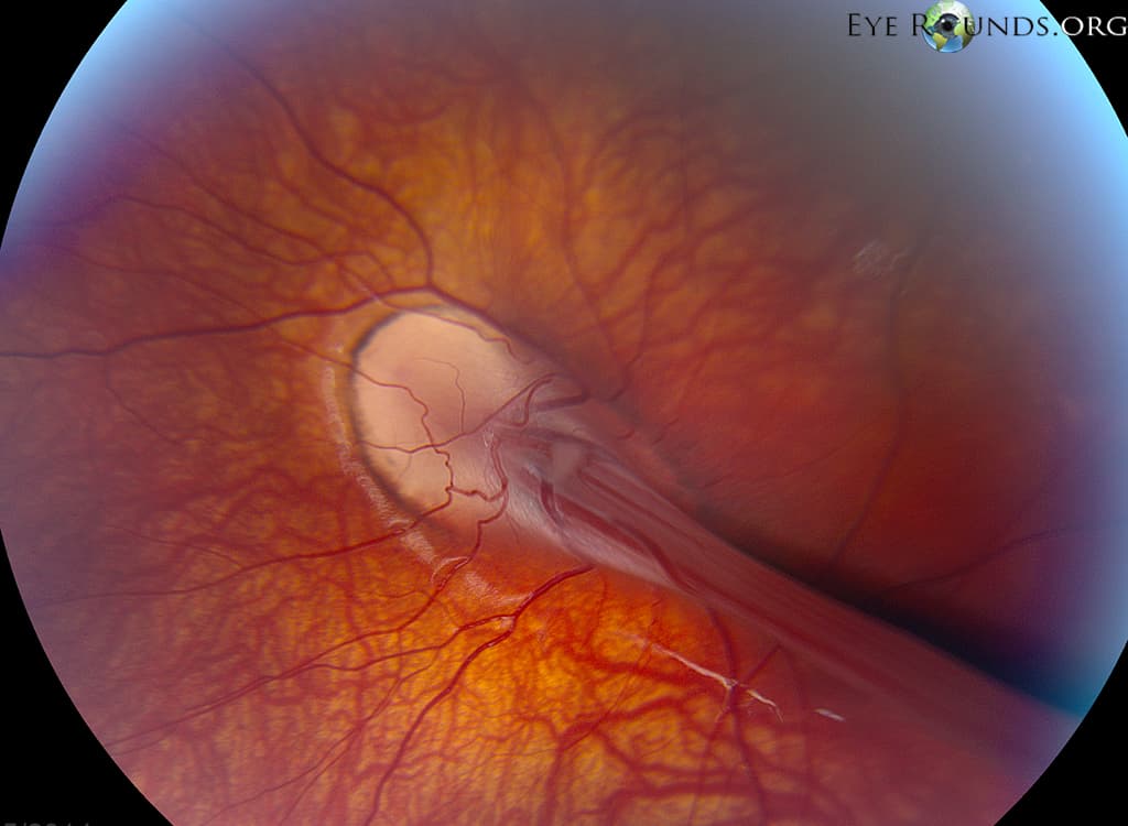 Clinical ophthalmic photograph of familial exudative vitreoretinopathy fevr3 - genetics condition
