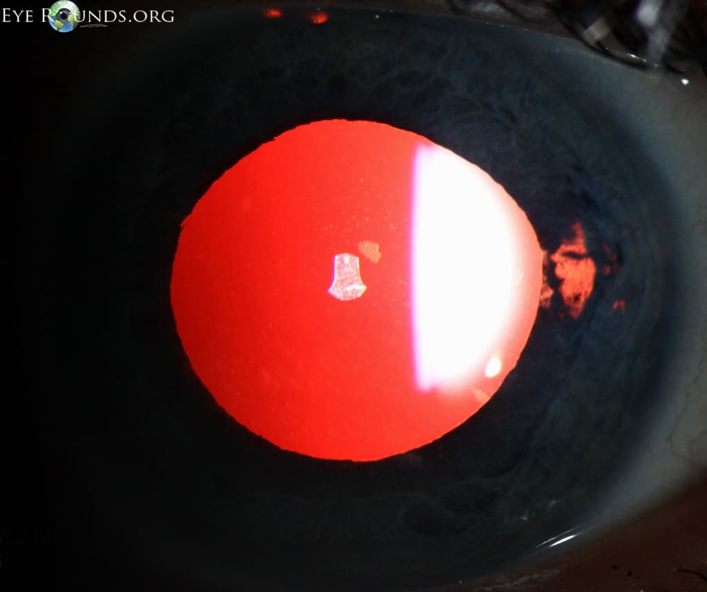 Clinical ophthalmic photograph of glaukomflecken - glaucoma condition