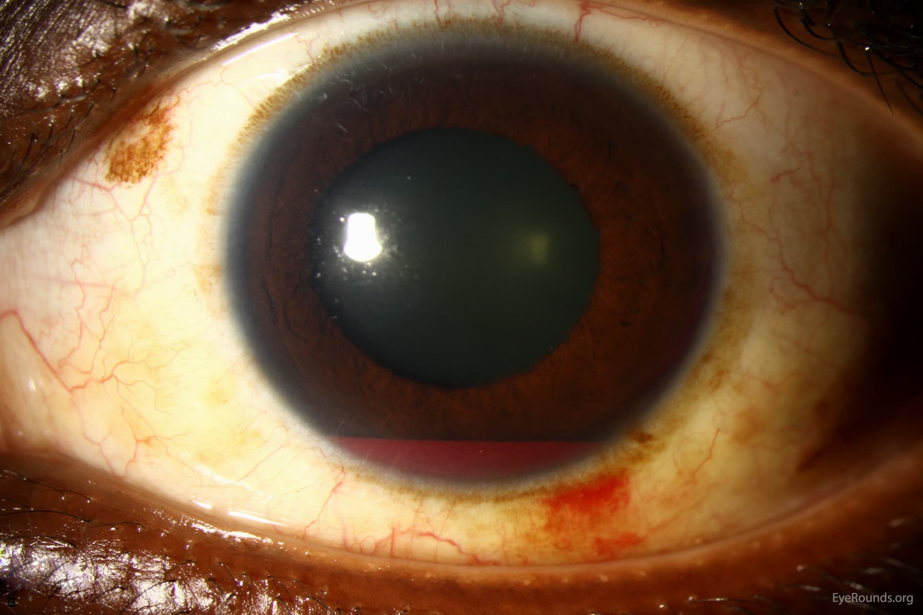 Clinical ophthalmic photograph of hyphema - glaucoma condition