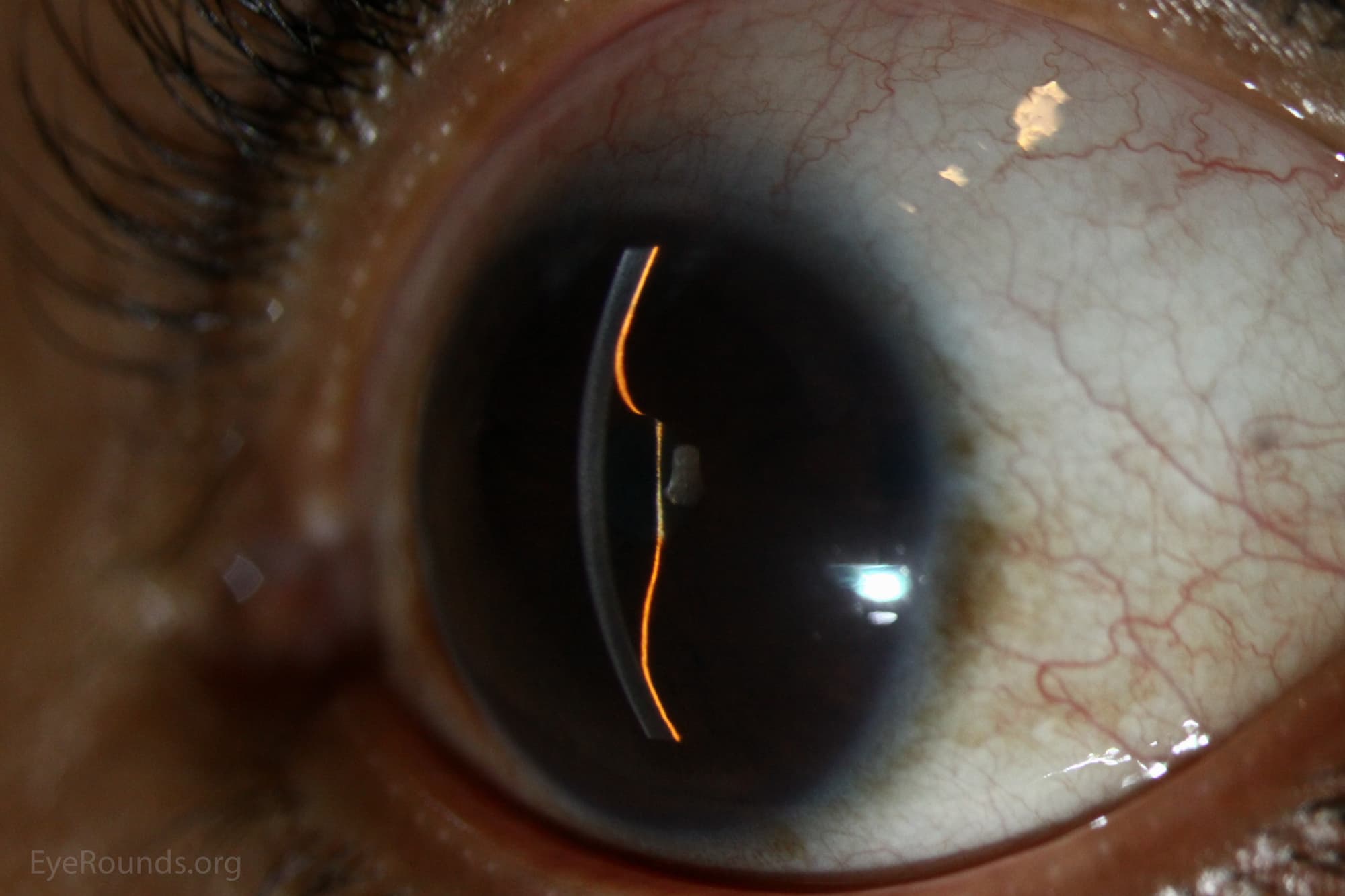 Clinical ophthalmic photograph of iris bombe - glaucoma condition