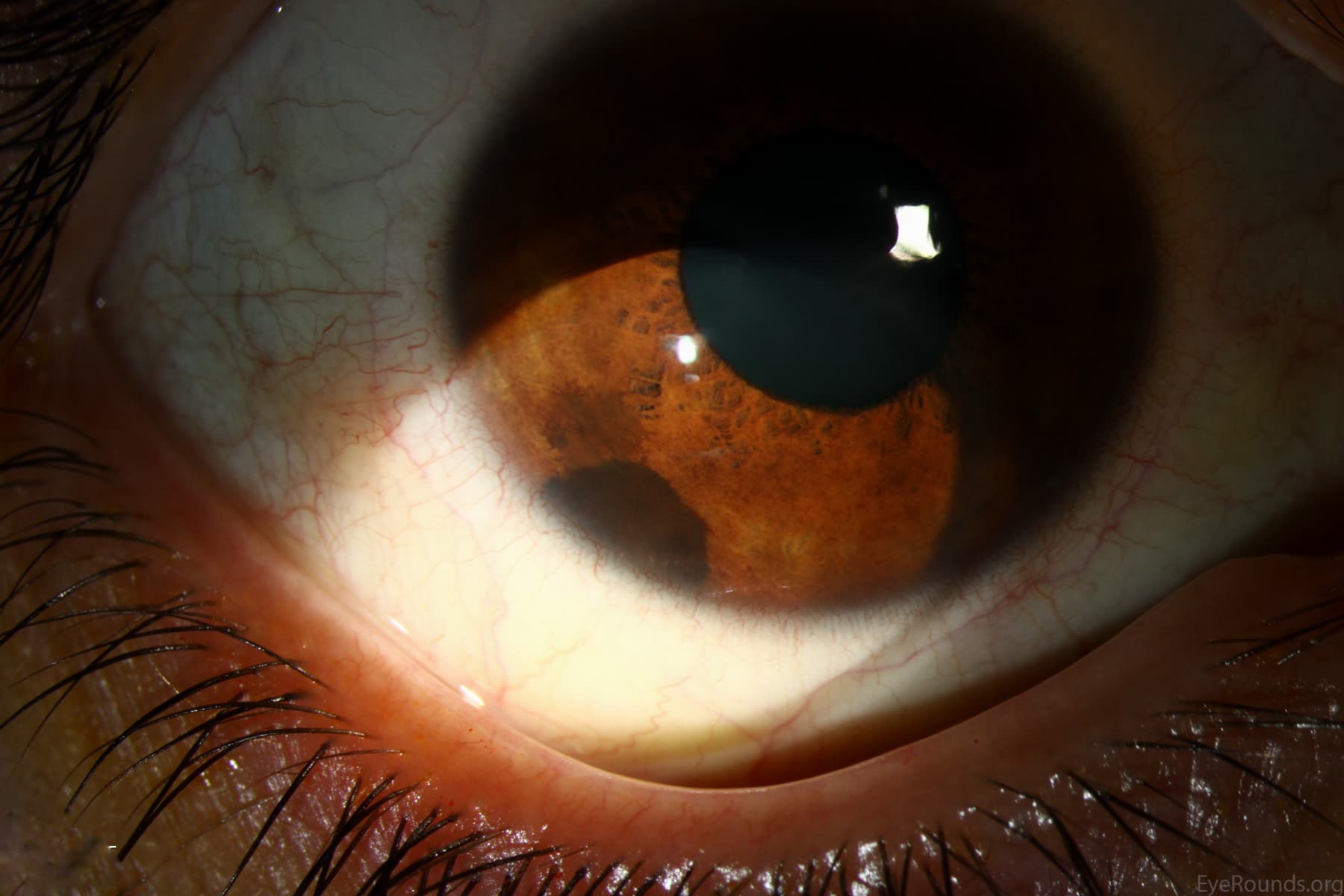 Clinical ophthalmic photograph of iris nevus - glaucoma condition
