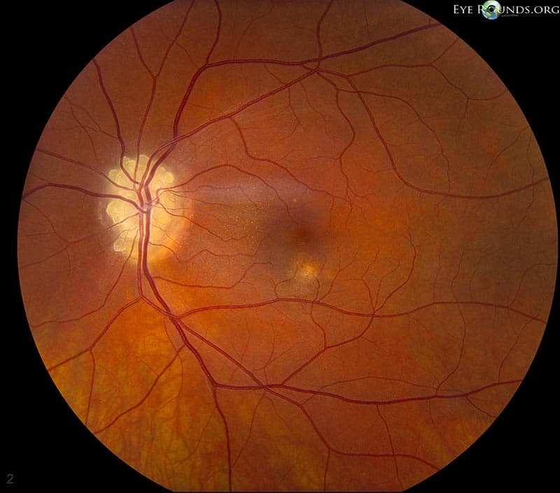 Clinical ophthalmic photograph of optic nerve head drusen - glaucoma condition