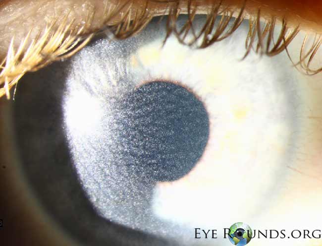 Clinical ophthalmic photograph of cystinosis - inherited disease condition