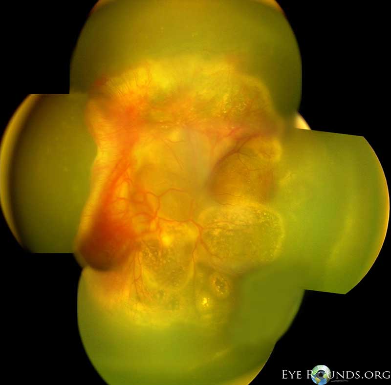 Clinical ophthalmic photograph of familial exudative vitreoretinopathy fevr - inherited disease condition