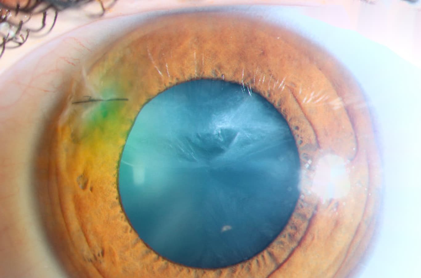 Clinical ophthalmic photograph of capsular violation - iris condition