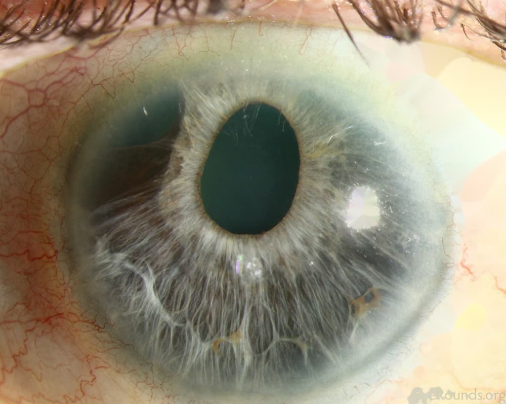 Clinical ophthalmic photograph of essential iris atrophy - iris condition