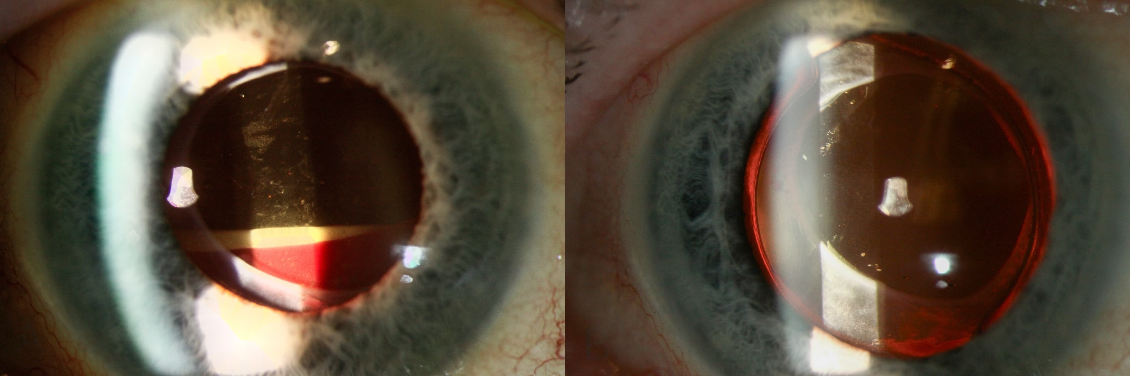 Clinical ophthalmic photograph of layered intracapsular hemorrhage following phacoemulsification gatt - iris condition