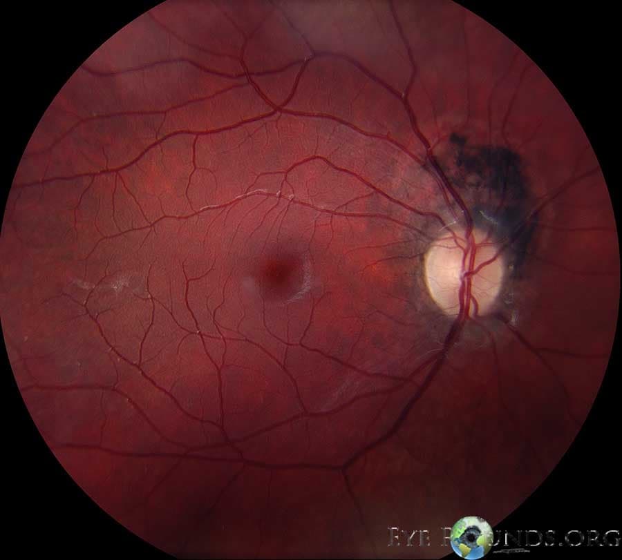 Clinical ophthalmic photograph of melanocytoma - iris condition
