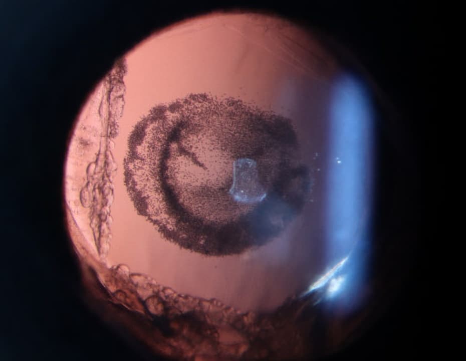 Clinical ophthalmic photograph of opacification of hydrophilic intraocular lens - iris condition